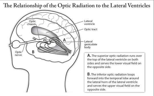 The Relationship of the Optic Radiation to the Lateral Ventriclese Relationship of the Optic Radiation to the Lateral Ventricles