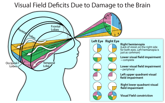 Visual field deficits due to damage to the brain